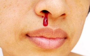 Image result for bloody nose photos